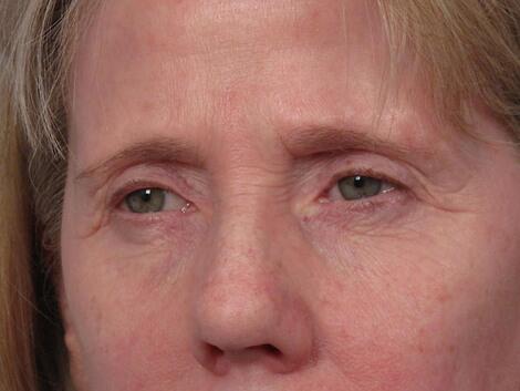 Eyelid Surgery Before & After Image