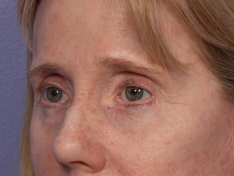 Eyelid Surgery Before & After Image