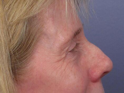 Eyelid Surgery Before & After Image