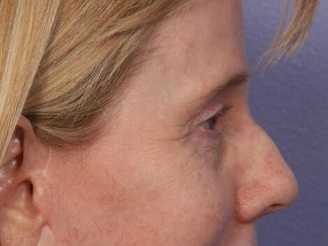 Eyelid Surgery Before & After Image