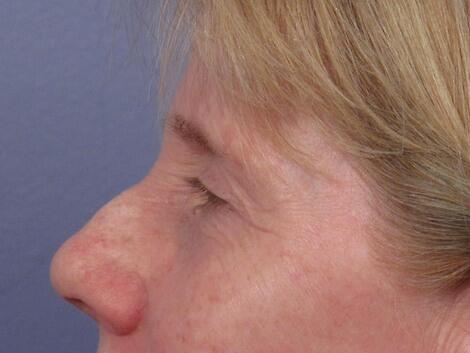 Eyelid Surgery Before & After Image