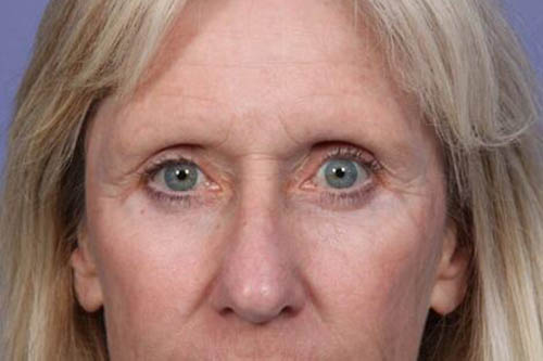 Eyelid Surgery Before & After Image