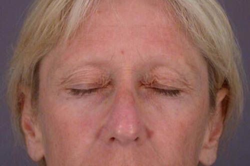 Eyelid Surgery Before & After Image