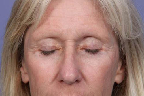 Eyelid Surgery Before & After Image