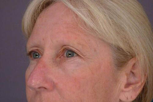 Eyelid Surgery Before & After Image