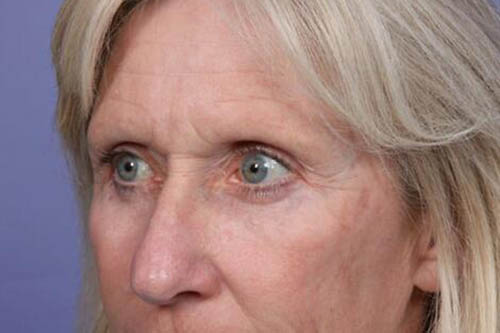 Eyelid Surgery Before & After Image