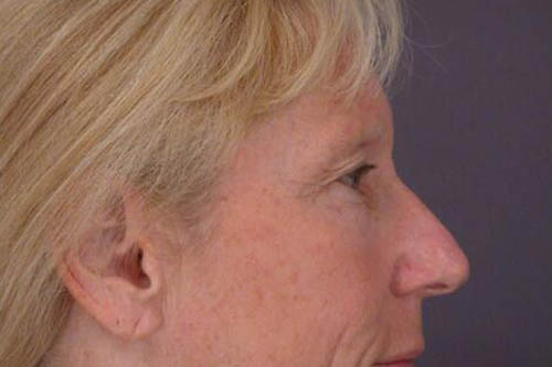 Eyelid Surgery Before & After Image