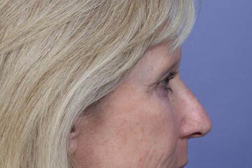 Eyelid Surgery Before & After Image