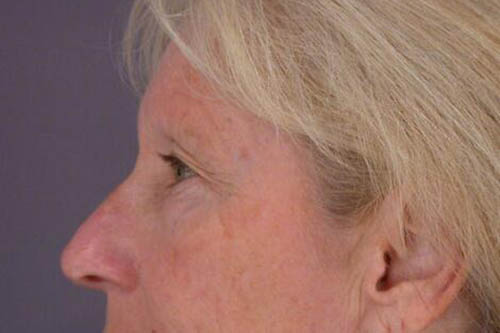 Eyelid Surgery Before & After Image