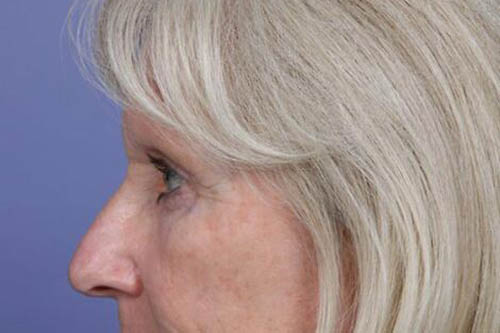 Eyelid Surgery Before & After Image