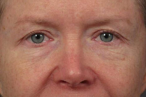 Eyelid Surgery Before & After Image