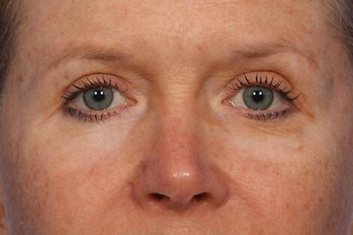 Eyelid Surgery Before & After Image