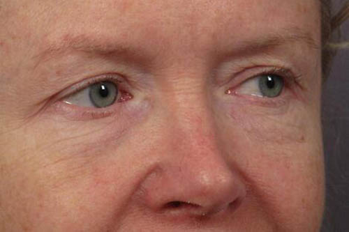 Eyelid Surgery Before & After Image