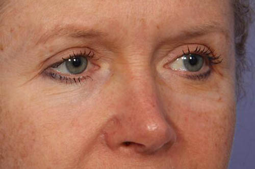 Eyelid Surgery Before & After Image