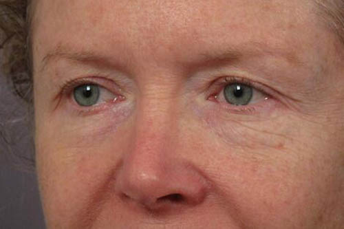 Eyelid Surgery Before & After Image