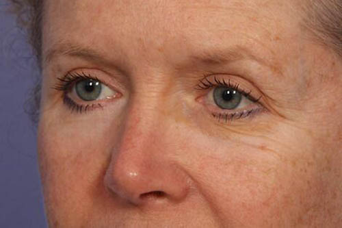 Eyelid Surgery Before & After Image