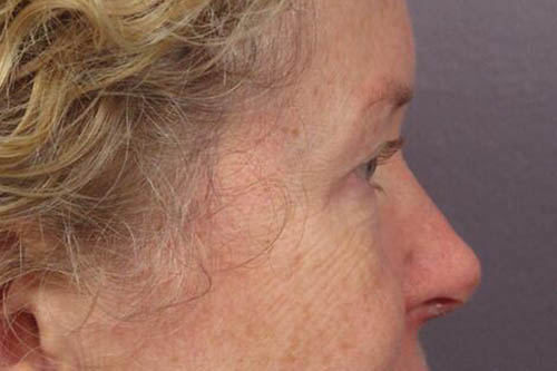 Eyelid Surgery Before & After Image