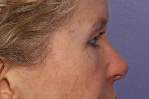 Eyelid Surgery Before & After Image