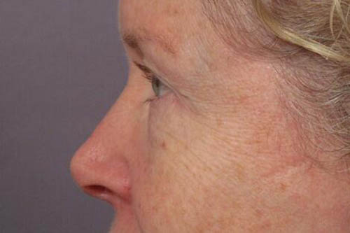 Eyelid Surgery Before & After Image