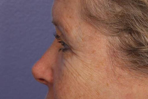 Eyelid Surgery Before & After Image