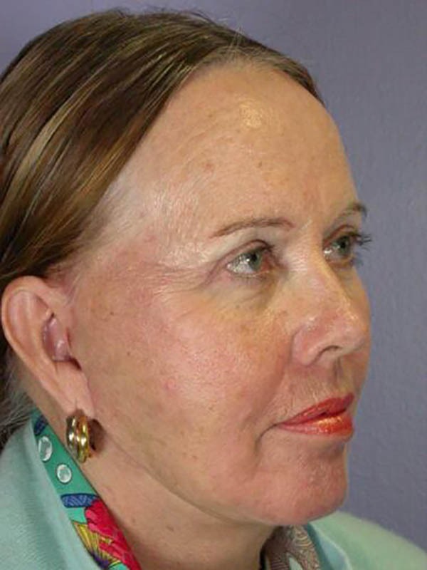 Eyelid Surgery Before & After Image