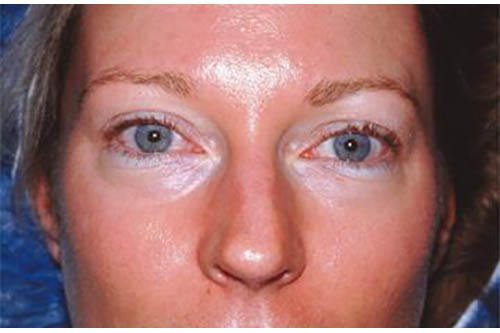 Eyelid Surgery Before & After Image