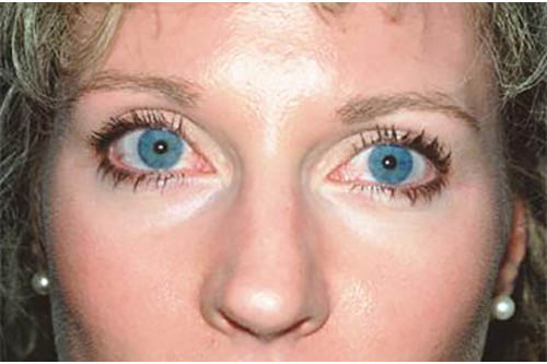 Eyelid Surgery Before & After Image