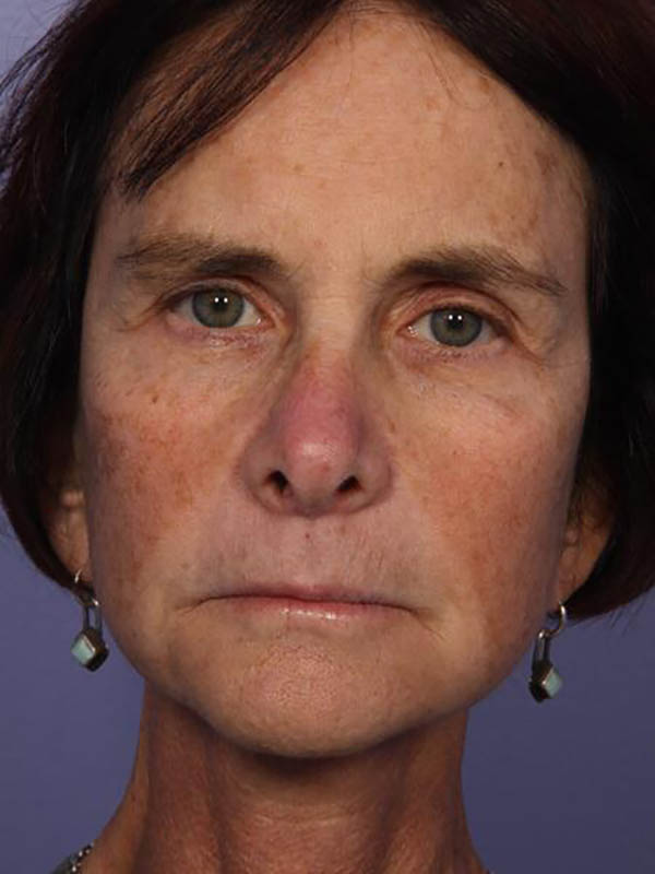 Eyelid Surgery Before & After Image