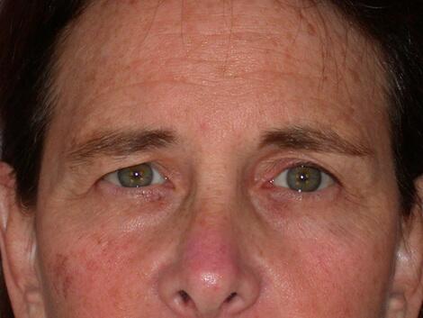 Eyelid Surgery Before & After Image