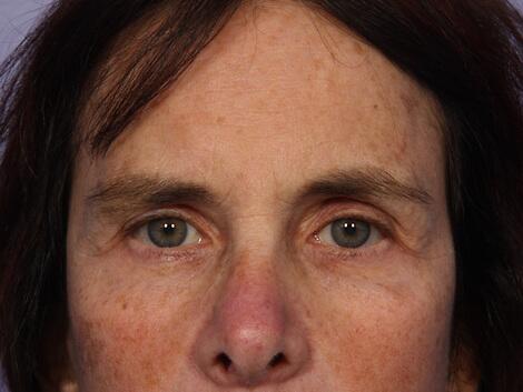 Eyelid Surgery Before & After Image