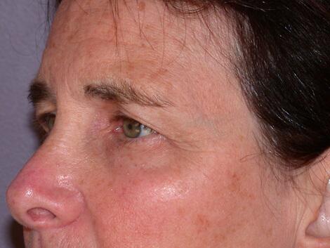 Eyelid Surgery Before & After Image