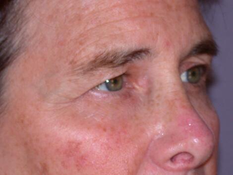 Eyelid Surgery Before & After Image