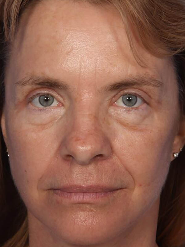 Eyelid Surgery Before & After Image