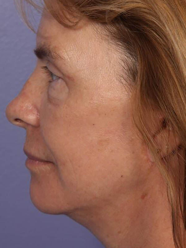 Eyelid Surgery Before & After Image