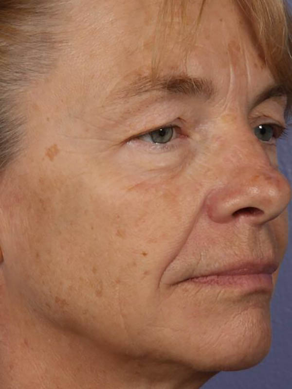 Eyelid Surgery Before & After Image