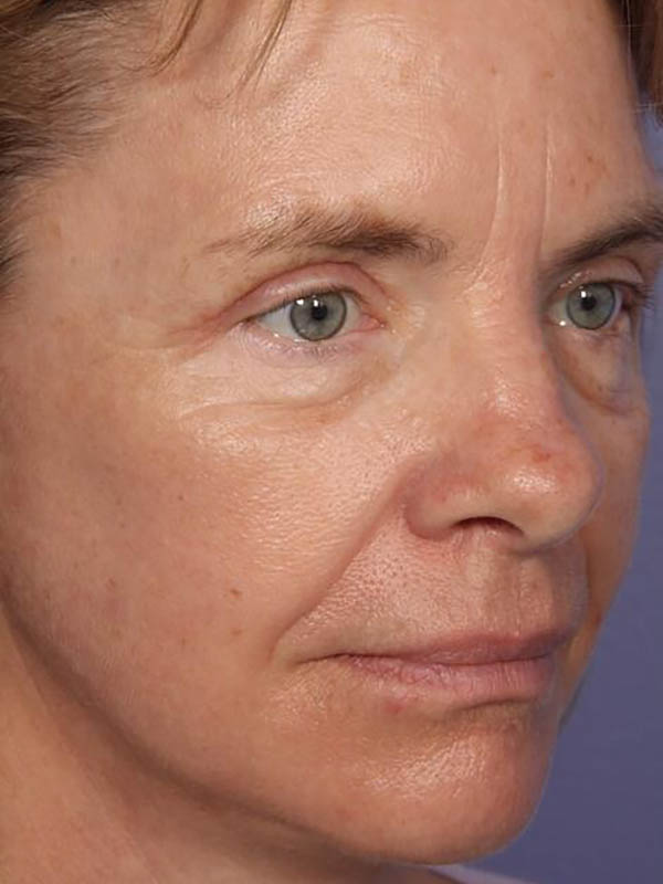 Eyelid Surgery Before & After Image