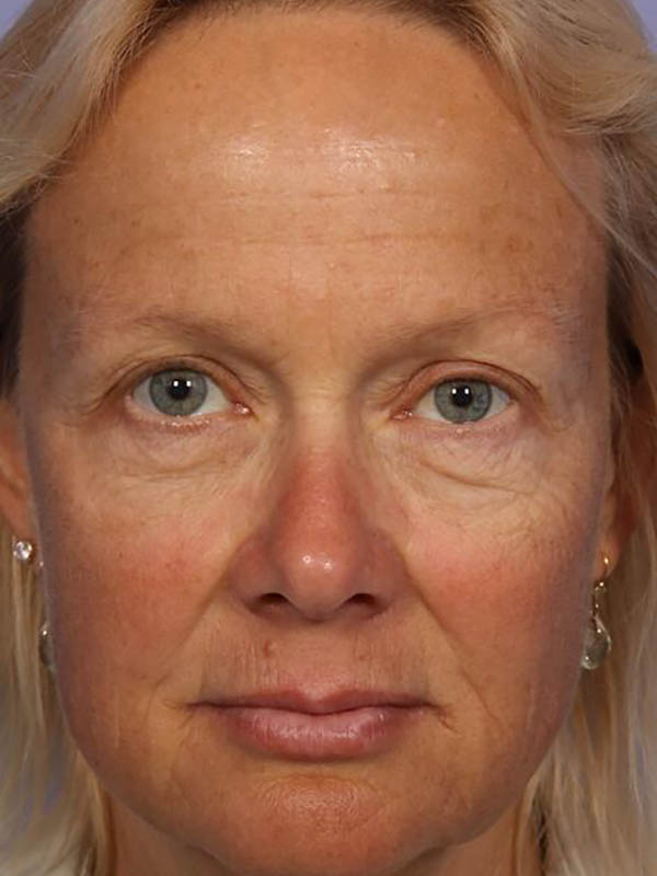 Eyelid Surgery Before & After Image