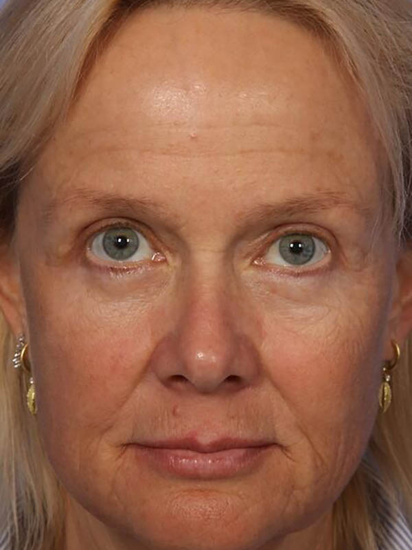 Eyelid Surgery Before & After Image