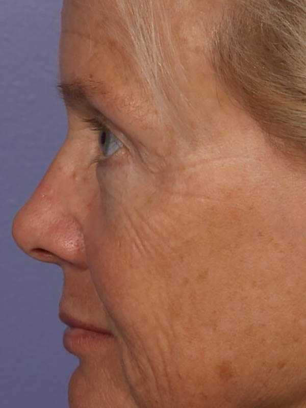 Eyelid Surgery Before & After Image