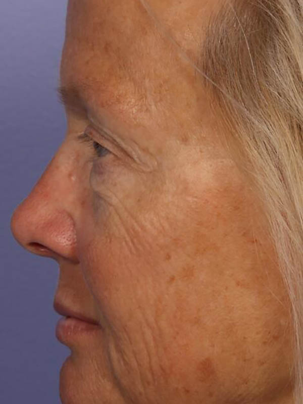 Eyelid Surgery Before & After Image