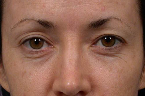 Eyelid Surgery Before & After Image