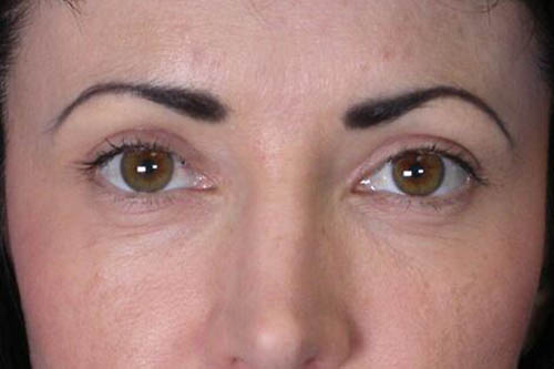 Eyelid Surgery Before & After Image