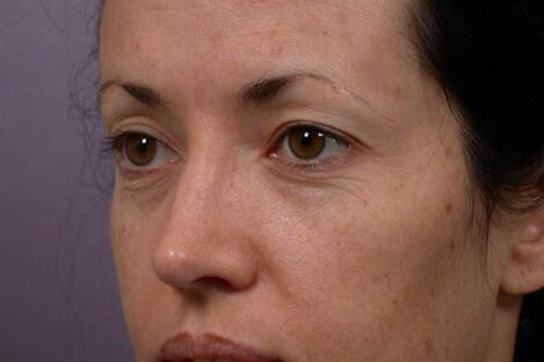 Eyelid Surgery Before & After Image