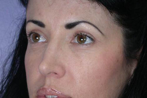 Eyelid Surgery Before & After Image