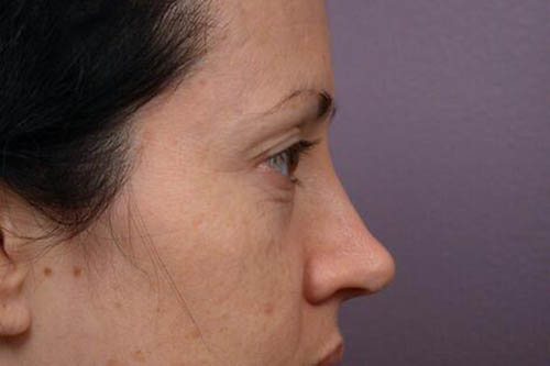 Eyelid Surgery Before & After Image