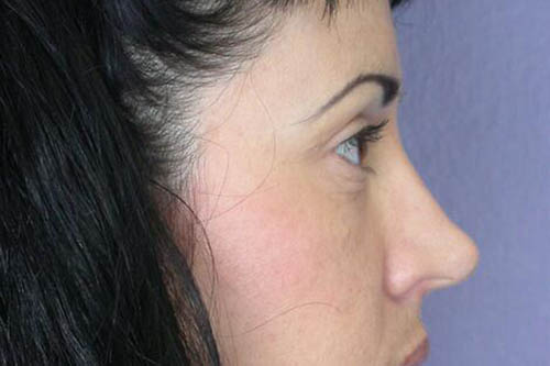 Eyelid Surgery Before & After Image