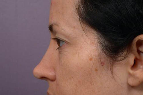 Eyelid Surgery Before & After Image