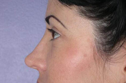 Eyelid Surgery Before & After Image