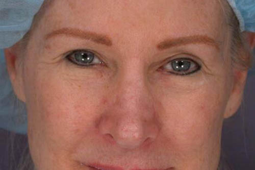 Eyelid Surgery Before & After Image