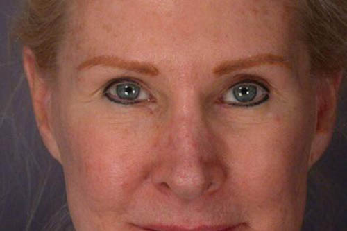 Eyelid Surgery Before & After Image